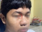 Potret bagian wajah seorang anak (disensor) yang mengalami luka memar di sekitar kelopak mata akibat dugaan penganiayaan oleh oknum polisi di Pacitan.