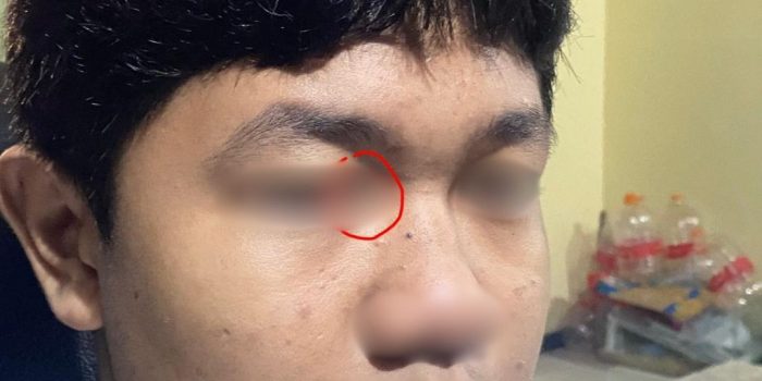 Potret bagian wajah seorang anak (disensor) yang mengalami luka memar di sekitar kelopak mata akibat dugaan penganiayaan oleh oknum polisi di Pacitan.