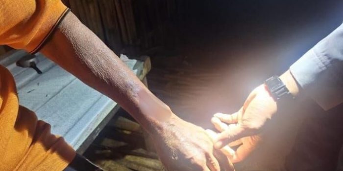 Kondisi luka pada lengan Pamuji (74), lansia di Arjosari Pacitan yang menjadi korban serangan benda tumpul saat memergoki pencuri.