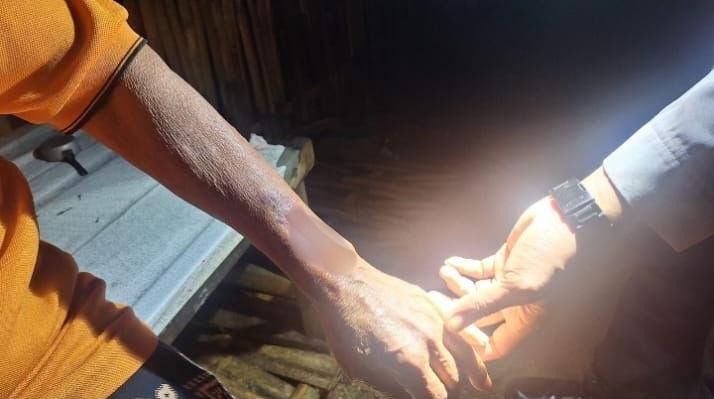 Kondisi luka pada lengan Pamuji (74), lansia di Arjosari Pacitan yang menjadi korban serangan benda tumpul saat memergoki pencuri.